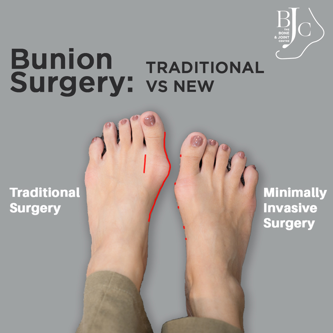 Bunion Surgeon Singapore