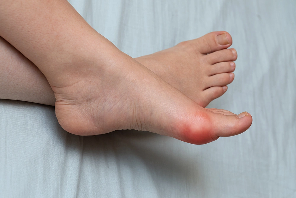 Bunion Surgery Recovery: How to Heal Safely and Comfortably 