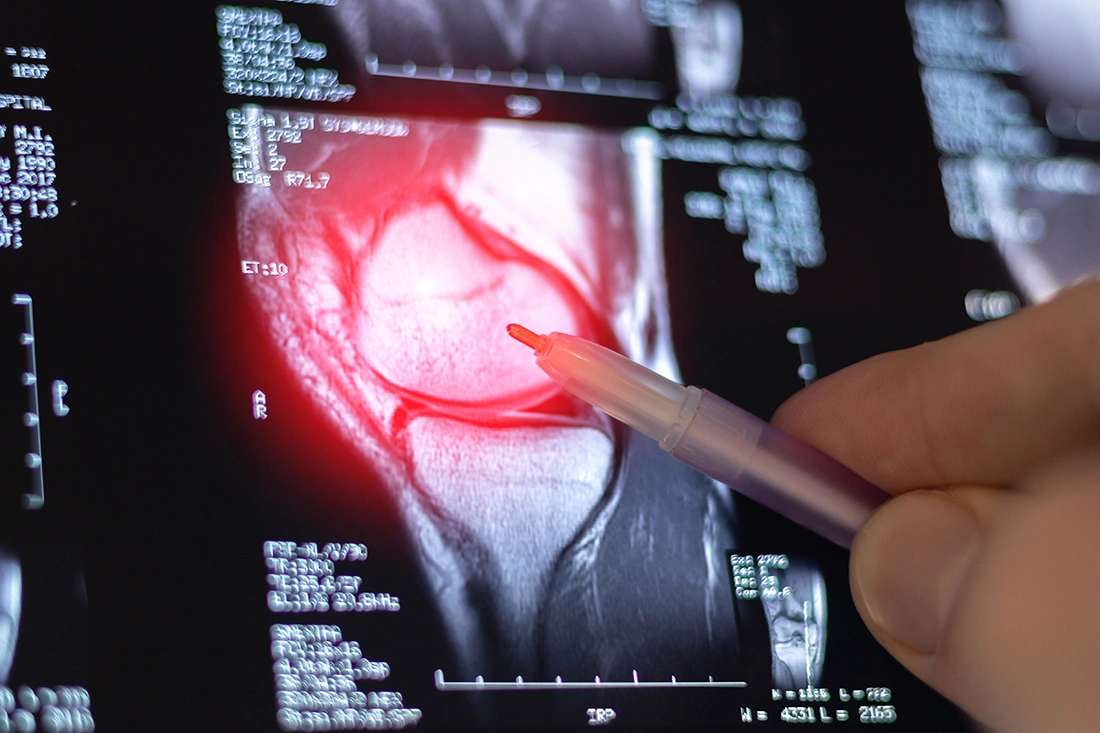 A close-up MRI scan of the knee